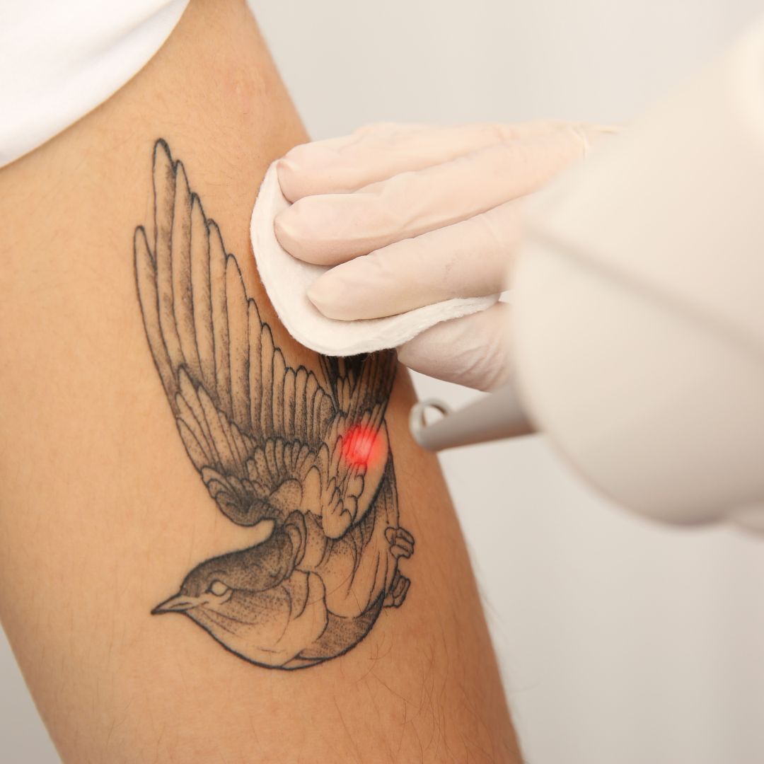 Becoming an Expert of Ink Reversal: Professional Tattoo Removal Training |  Spectrum Science & Beauty